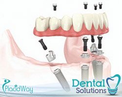 Slider image (3) Dental Solutions Los Algodones